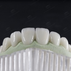 Răng sứ Zirconia